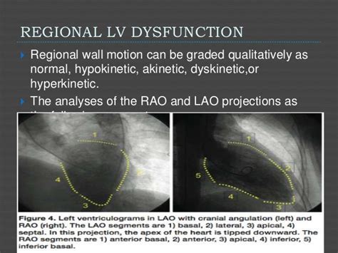 lv gram left ventriculogram|left ventricular angiogram procedure.